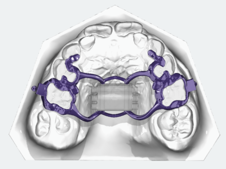 Tooth-Borne Rapid Palatal Expander