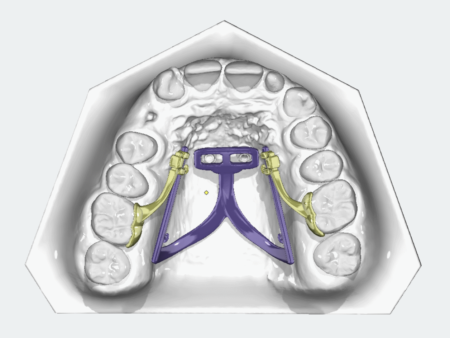 Distal-Slider