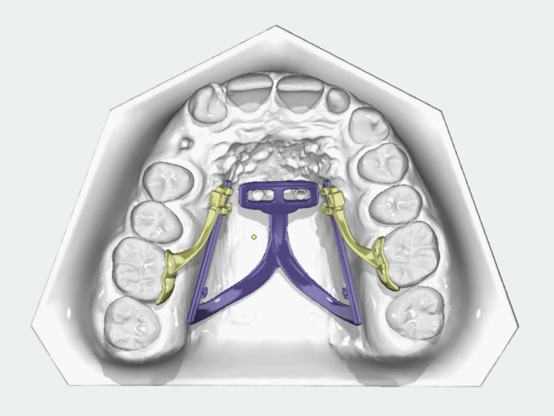 Distal-Slider